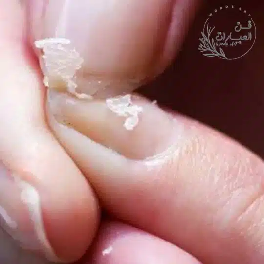 علاج نقص كالسيوم الدم